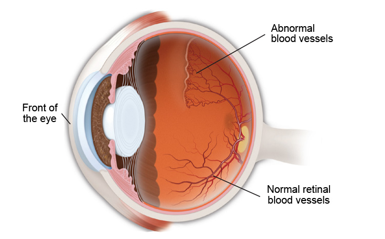 Retinopathy of prematurity (ROP) is an eye disease that occurs in a small percentage of premature babies. In ROP, abnormal blood vessels grow on the retina 