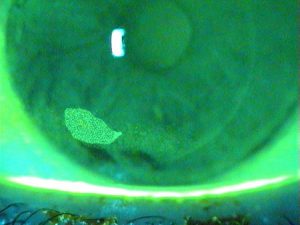 Corneal Tear